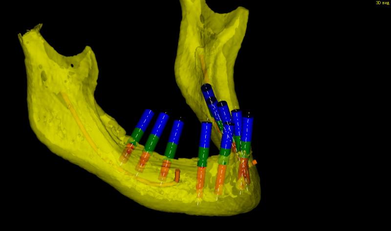 Планирование установки имплантантов на компьютере 3D вид с права